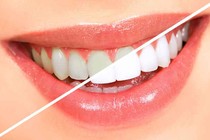 Thực phẩm rẻ tiền làm trắng răng