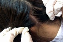 Thảo dược trị nấm da đầu