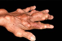 Thèm thực phẩm đang kiêng do bị gút