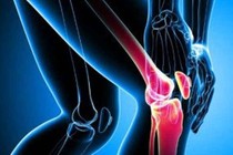 Thoái hóa khớp không nên điều trị theo truyền miệng