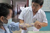 Vì sao bệnh thủy đậu lành tính nhưng có thể biến chứng chết người?