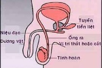 Sau triệt sản nam muốn có con trở lại được không?