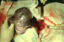 Cách phát hiện khối u buồng trứng