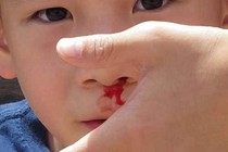 U xơ vòm mũi họng chảy máu dễ mất mạng