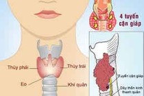 Mạch nhanh, mắt sáng long lanh nghĩ ngay u tuyến giáp
