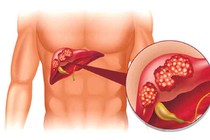 Nhận biết dấu hiệu ung thư gan để phòng tránh