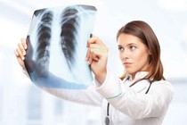 Dấu hiệu sớm của ung thư phổi không nên bỏ qua