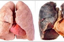 Chụp Xquang phát hiện ung thư phổi