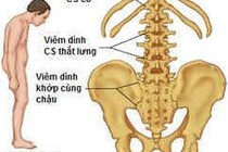 Viêm cột sống dính khớp có yếu tố gia đình không?