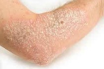 Phòng trị vẩy nến bằng Đông y