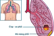 Phát hiện viêm mủ màng phổi giai đoạn sớm