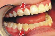 Viêm nha chu liên quan đến đái tháo đường