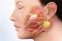 Viêm tuyến nước bọt và cách xử lý