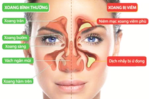 Cách nhận biết viêm xoang mặt