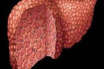 Xơ gan nên có chế độ ăn như thế nào?