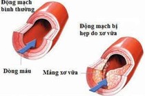 Xơ vữa mạch vì không uống thuốc