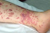 Có thể tử vong vì xuất huyết giảm tiểu cầu