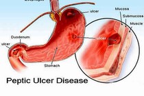 Người xuất huyết tiêu hóa không ăn uống đồ dễ sinh hơi