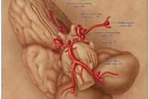 Sự ác hiểm của phình động mạch não