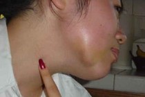Răng số 8 mọc lệch