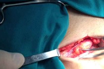 Phòng ngừa thoát vị đĩa đệm rất quan trọng