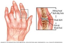 Viêm khớp dạng thấp không thể chữa khỏi