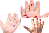 Bấm huyệt phục hồi cận thị