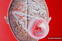 Đau mắt cẩn thận phồng động mạch não dễ tử vong