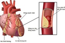Có thuốc trị hết hẹp động mạch vành không?