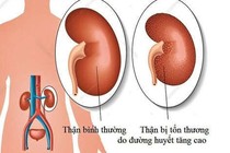 Cách phát hiện sớm suy thận do đái tháo đường