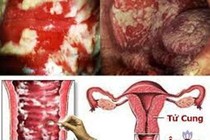  Vợ  viêm âm đạo tái phát vì chồng không điều trị