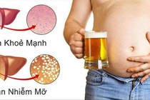 Chăm uống rượu, lười vận động khiến gan nhiễm mỡ