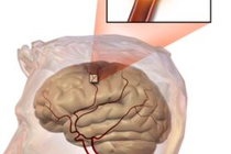 Đột quỵ não do tắc nhánh lớn của động mạch não
