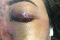Mù mắt vì tiêm filler làm đẹp