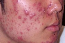 Thảo dược trị mụn trứng cá
