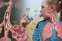 Đông y trị viêm phế quản thể hen ở trẻ