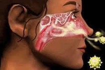 Kích thích huyệt trị viêm mũi cấp