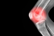 Biểu hiện của u xương sụn