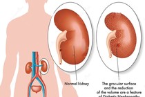 Điều trị hội chứng thận hư