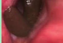 Ho ra máu vì đỉa chui khí quản