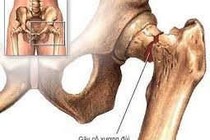 Điều trị gãy xương sau thay khớp háng