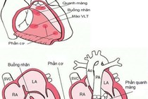 Chẩn đoán trước sinh phát hiện bệnh thông liên thất
