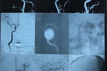  Túi phình mạch máu não: Những “quả bom nổ chậm”