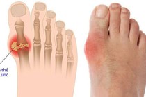 Bài thuốc hay phòng trị bệnh gút 
