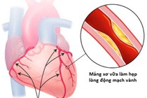Bệnh động mạch vành không đau ngực