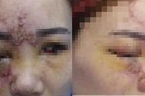 14 tuổi mù hai mắt và hoại tử mũi vì tiêm filler