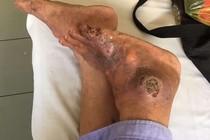 Bệnh gút cẩn thận hạt tophi lở loét gây tàn phế