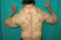Thích uống rượu sinh bệnh u mỡ 