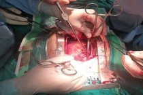 Cứu sống bệnh nhân vỡ tim