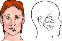 Cải thiện di chứng méo miệng sau tai biến mạch máu não bằng cách nào?